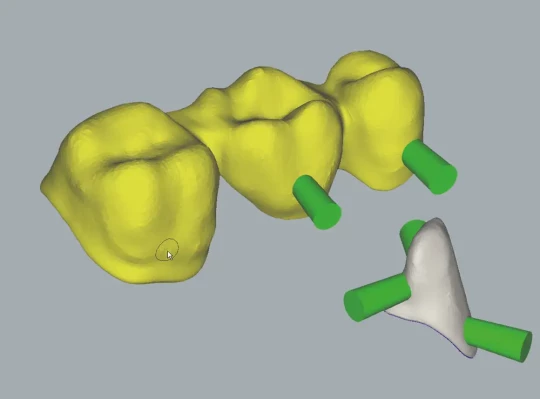 hyperMILL d'OPEN MIND, fao usinage pour la fabrication d'implants et d'autres appareillages médicaux