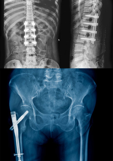 vis fixation vertebre bassin